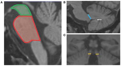Middle Cerebellar Peduncle Width—A Novel MRI Biomarker for FXTAS?